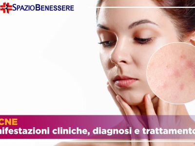 Acne: tipologia, diagnosi e trattamento