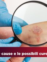 Le Dermatiti: tipi cause e cure