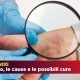 Le Dermatiti: tipi cause e cure