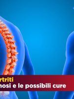 Spondiloartrite: i tipi, le cause, la diagnosi, le cure