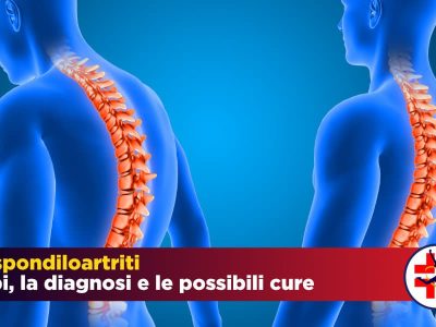 Spondiloartrite: i tipi, le cause, la diagnosi, le cure