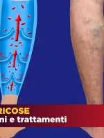 Le vene varicose: Cause, sintomi e cure
