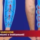 Le vene varicose: Cause, sintomi e cure