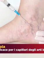 La scleroterapia: Trattamento capillari arti inferiori