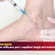 La scleroterapia: Trattamento capillari arti inferiori