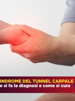 La sindrome del tunnel carpale: dalla diagnosi alle cure