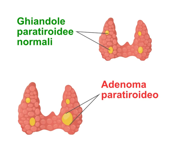 Adenoma paratiroideo
