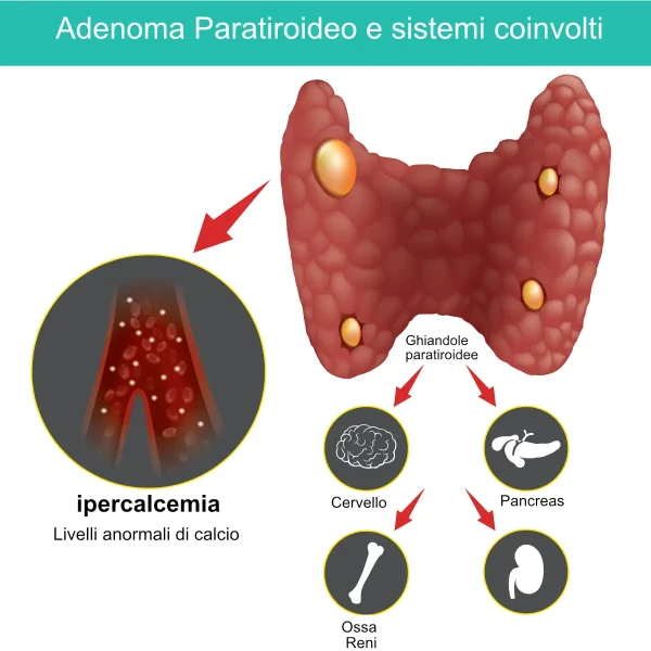 Adenoma paratiroideo e sistemi coinvolti