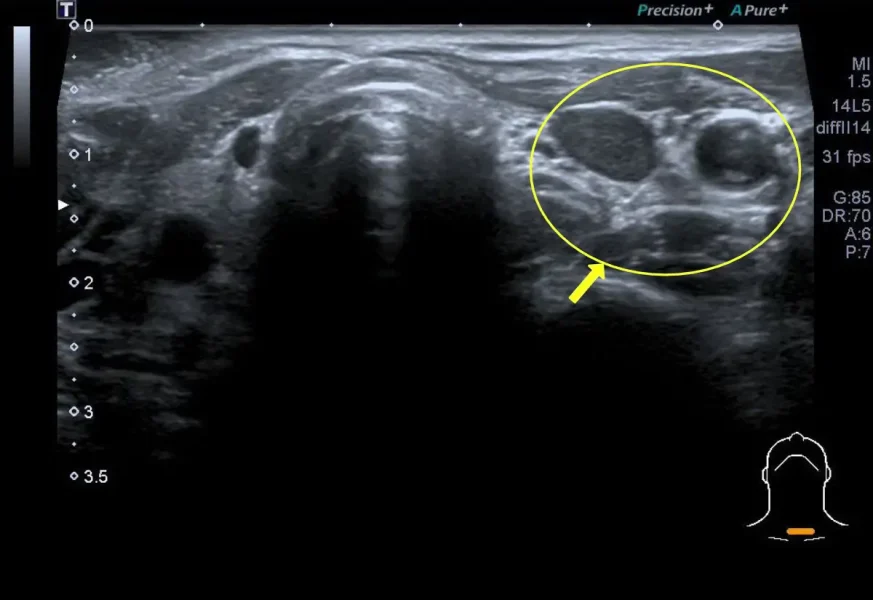 Ecografia - Adenoma Paratiroide 
