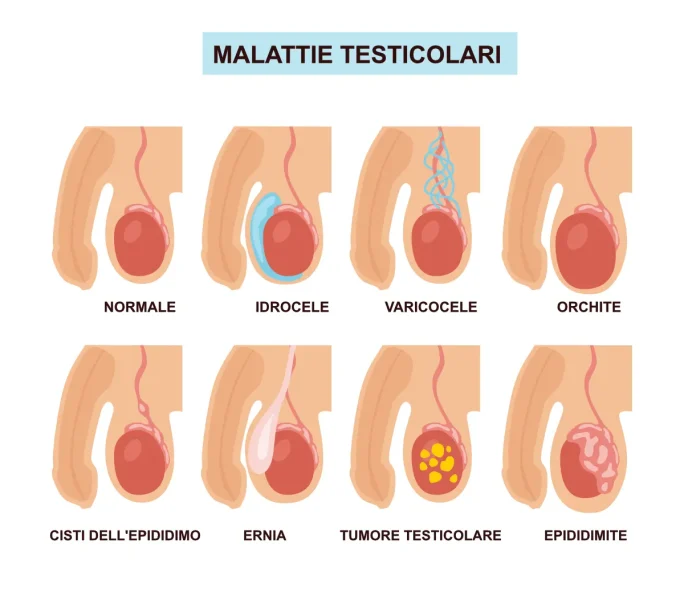 Infografica con le principali malattie testicolari