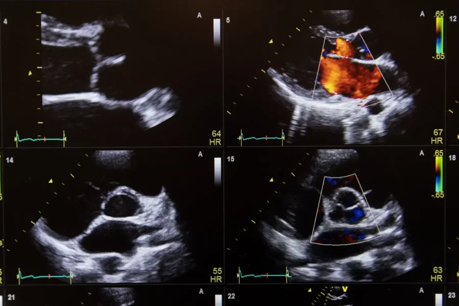 Ecocolordoppler Cardiaco