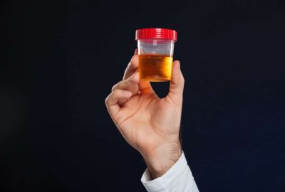 Diagnosi Cistite Interstiziale: Esami delle Urine Esami delle Urine