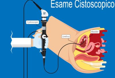 Esame Cistoscopico per diagnosi Cistite Interstiziale Esame Cistoscopico per diagnosi Cistite Interstiziale
